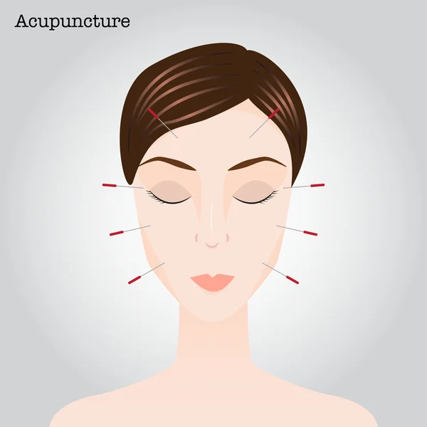 Woman getting an acupuncture treatment