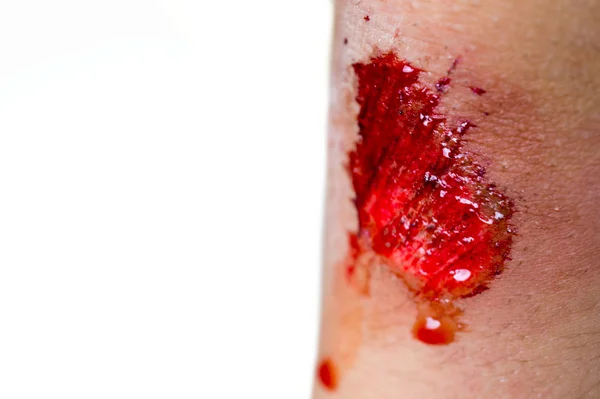 Boy child with bleeding knee wound, clipping path included