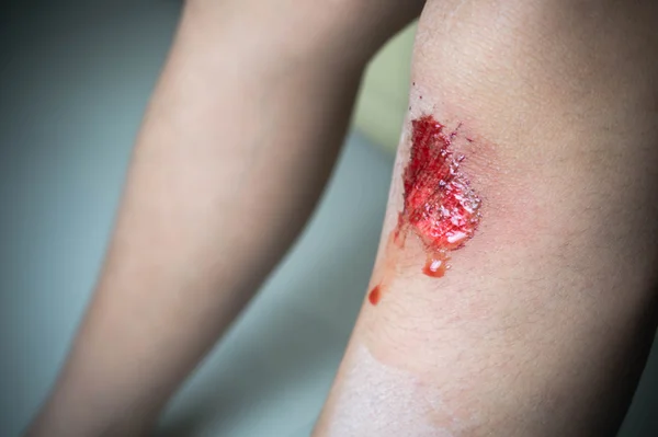 Boy child with bleeding knee wound