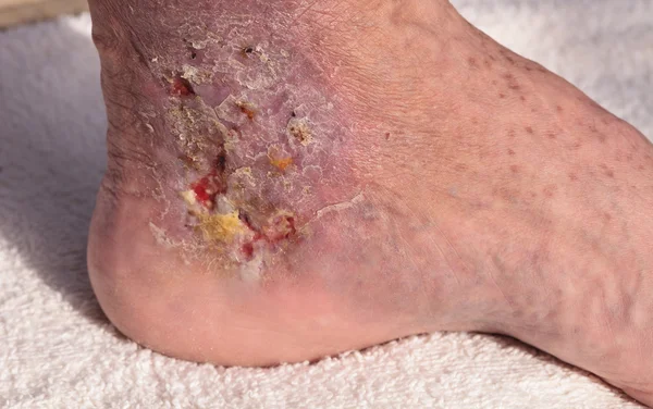 Medical picture: Infection cellulitis on the skin of an ankle