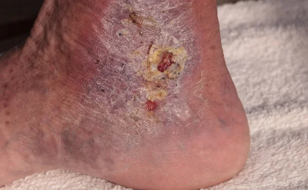 Medical picture: Infection cellulitis on the skin of an ankle