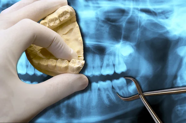 Dentist hand show molar teeth