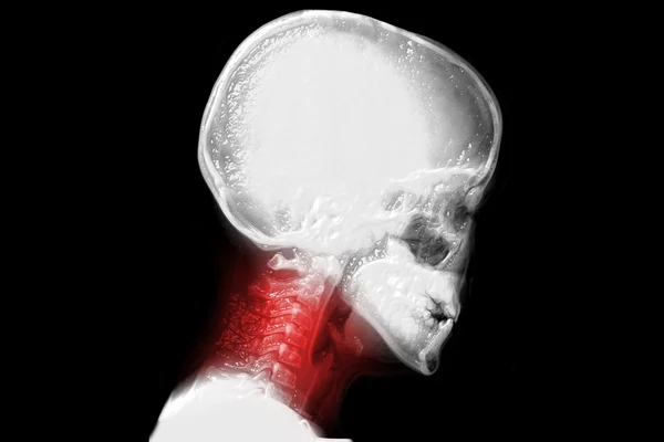 Human cervical vertebrae, neck pain