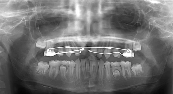 Dental scan with fixed appliance