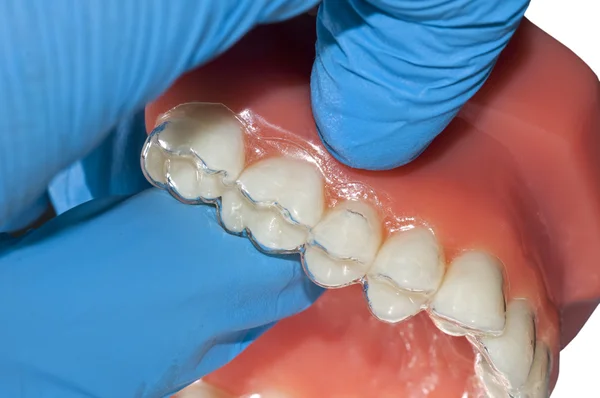 Clear aligner close up