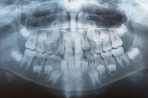 X-ray  teeth