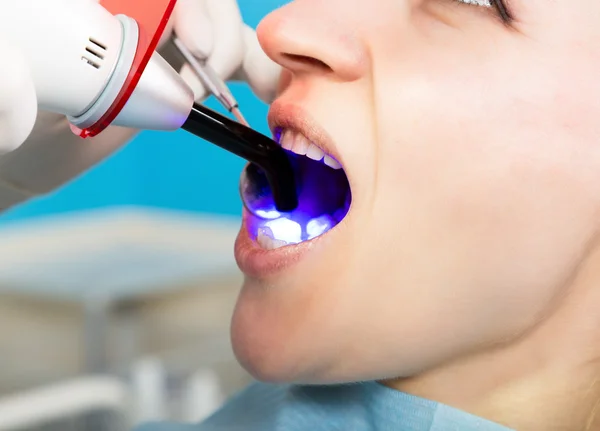 The reception was at the female dentist. Doctor examines the oral cavity on tooth decay. Caries protection. Tooth decay treatment. Dentist working with dental polymerization lamp in oral cavity