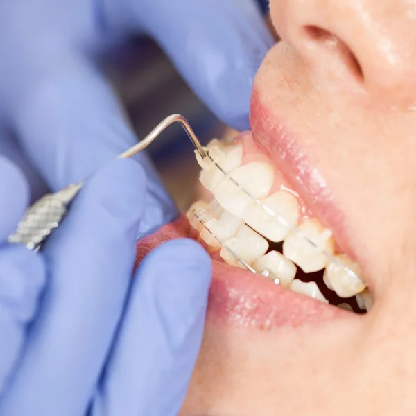 Orthodontist working with ceramic braces