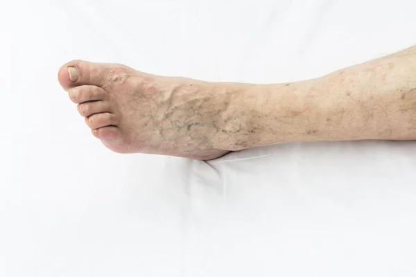 Varicose veins on the left leg