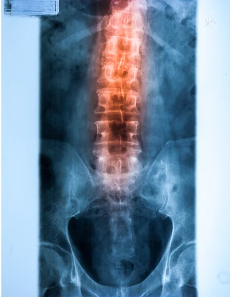 X ray MRI - Image of Spinal Column Neck pain