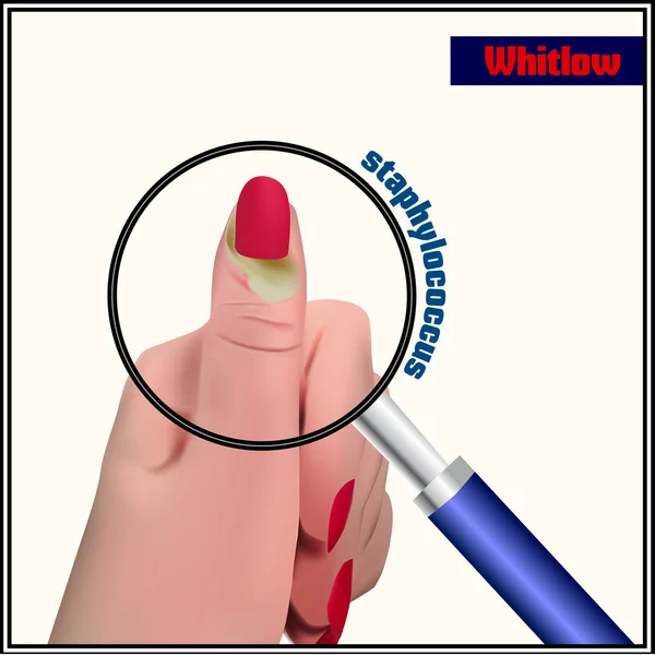 Whitlow. An abscess in the soft tissue near a fingernail.