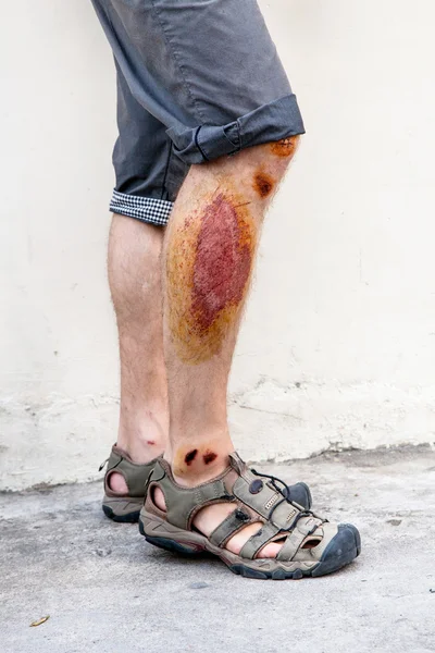 Wounds on the man\'s legs