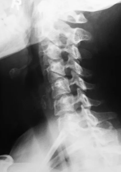 X-ray picture of neck