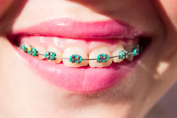 Smiling girl with braces