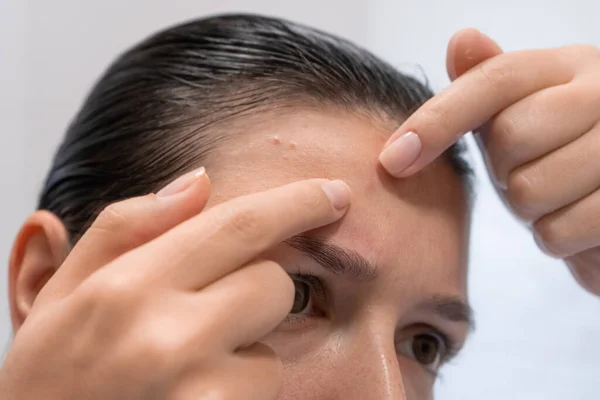 Close Portrait Girl Squeezes Out Pimple Her Forehead Awkward Moment — Stock Photo, Image