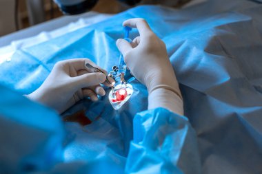 Profesyonel bir göz doktoru mikroskopla göz ameliyatı yapar. Cerrahın elleri yakın çekim. Ameliyat sırasında göz kapağı genişlemiş. Endoskopik göz ameliyatı. tıbbi ekipman.