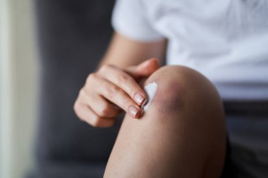 Yaralı diz eklemlerini iyileştirmek için krem süren birine yaklaş. Dizinde çürük var. Bacak ağrısı..