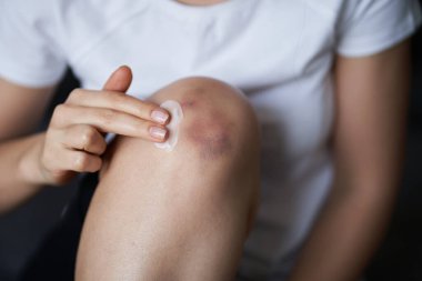 Yaralı diz eklemlerini iyileştirmek için krem süren birine yaklaş. Dizinde çürük var. Bacak ağrısı..