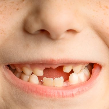 Ön dişleri dökülmüş bir çocuğun yüzüne yakın çekim.