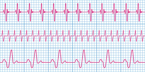 Elektrokardiogram mönster — Stock vektor