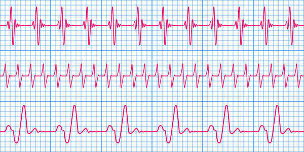 Cardiogram pattern