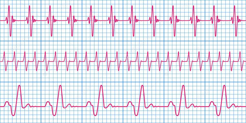Cardiogram pattern