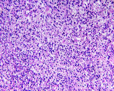Bir insan rhabdomyosarcoma