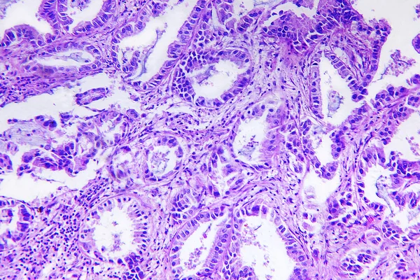 Adenocarcinoma bien diferenciado de un ser humano — Foto de Stock