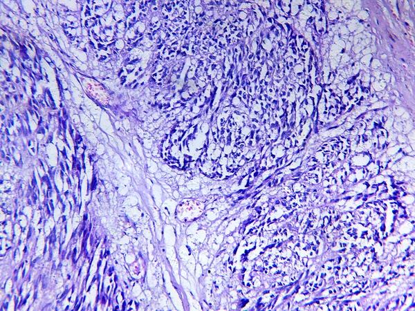 Leiomyosarcoma van een mens — Stockfoto