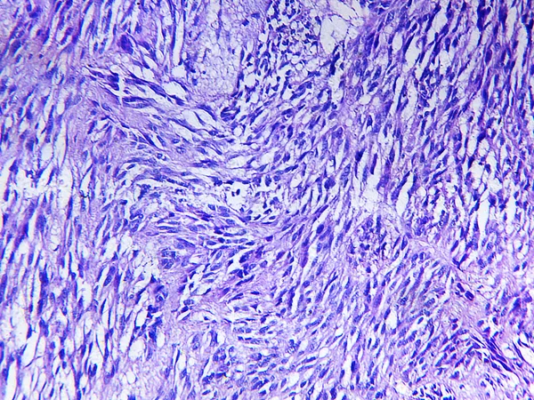 인간의 Leiomyosarcoma — 스톡 사진