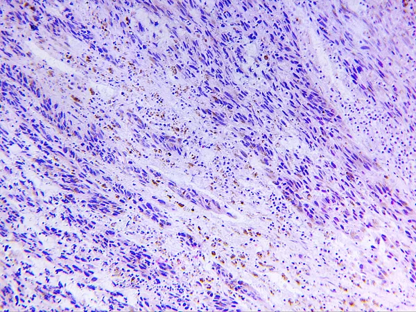 Melanoma, az emberi — Stock Fotó