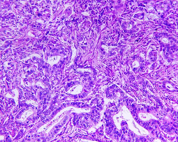 Adenocarcinoma gástrico de um humano — Fotografia de Stock