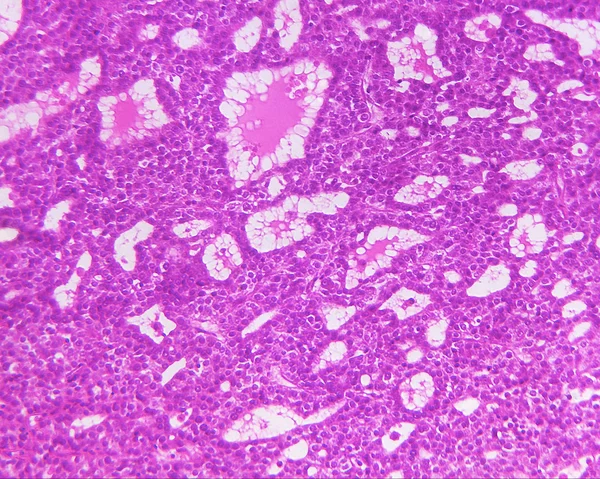 Carcinoma hepatocelular de um humano — Fotografia de Stock