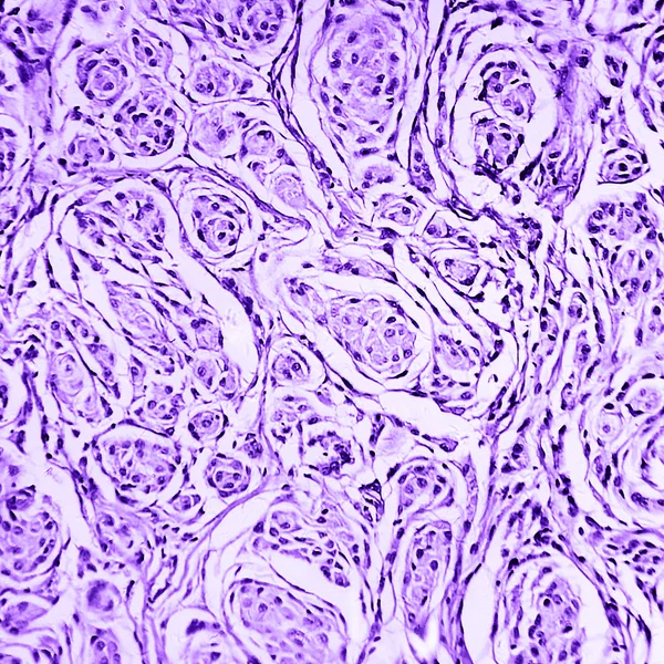 인간의 두뇌 astrocytoma — 스톡 사진