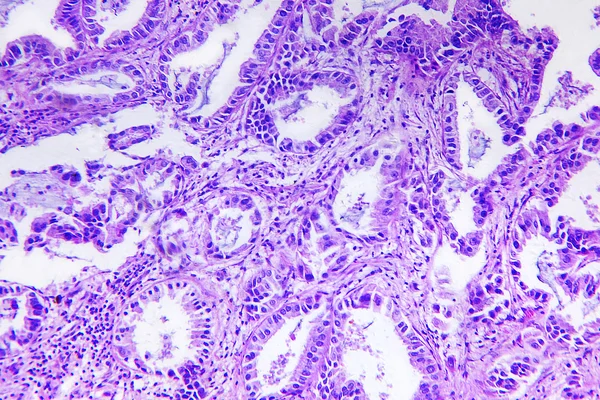 高分化的腺癌的一个人 图库照片