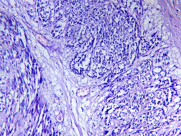 Leiomyosarcoma van een mens Stockafbeelding
