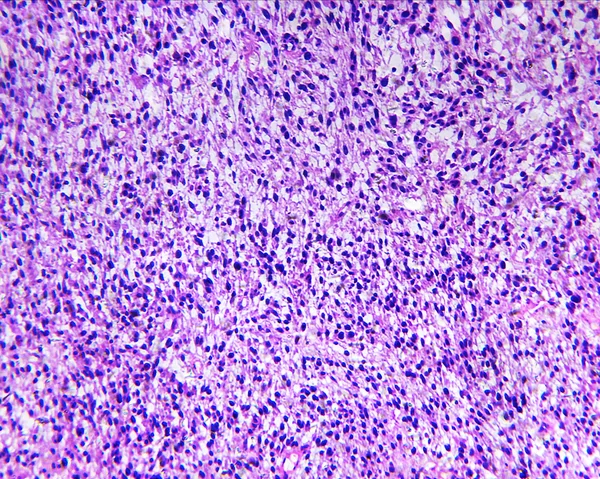 인간의 Rhabdomyosarcoma 스톡 사진