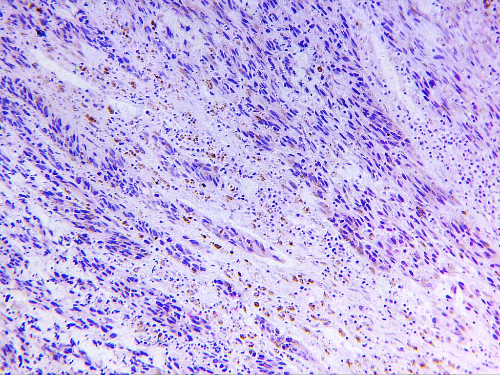 Melanoma of a human