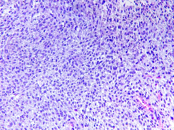 Fibrosarcoma ενός ανθρώπου — Φωτογραφία Αρχείου