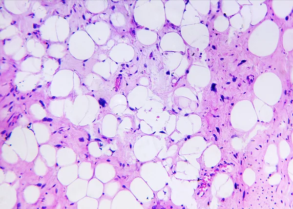 Liposarcoma di un umano — Foto Stock