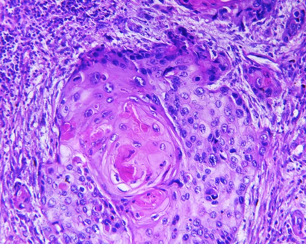 Plaveiselcelcarcinoom van een mens Stockfoto