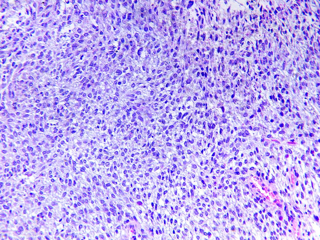 Fibrosarcoma of a human