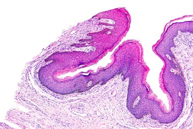 Skin papilloma of a human clipart