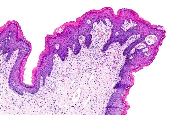 Papiloma de la piel de un humano —  Fotos de Stock