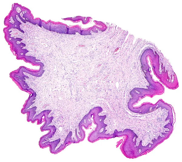 Papilloma della pelle di un umano — Foto Stock