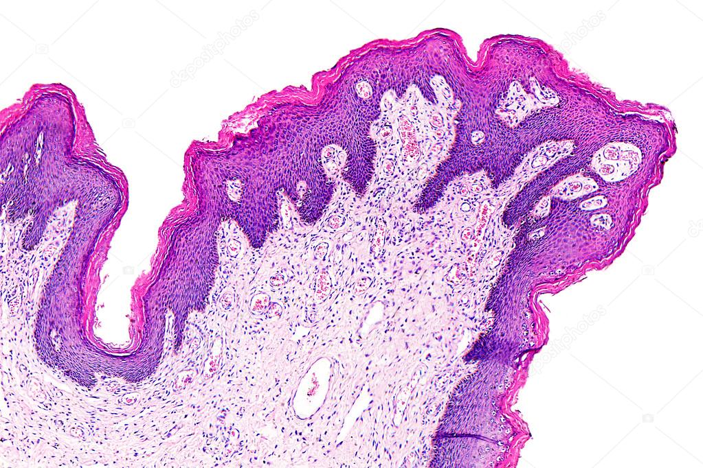 Skin papilloma of a human