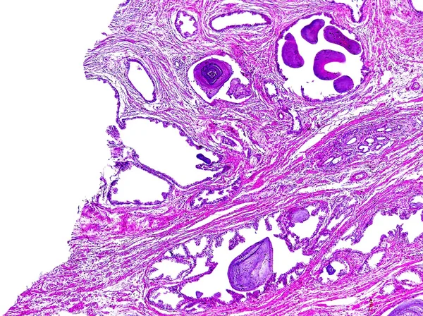 人間の前立腺肥大症 — ストック写真