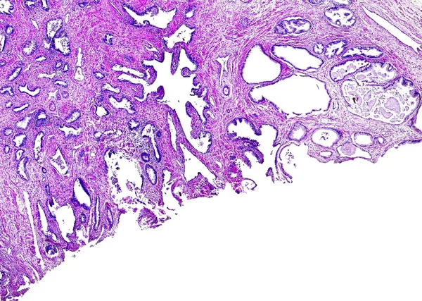 인간의 전립선 암 — 스톡 사진