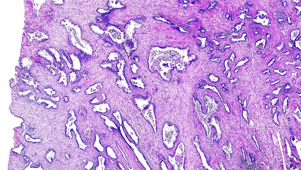 인간의 전립선 암 스톡 사진