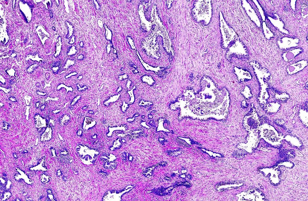 Cancer de prostata histologia Histologia adenocarcinom tubular a prostatei 6 7 puncte